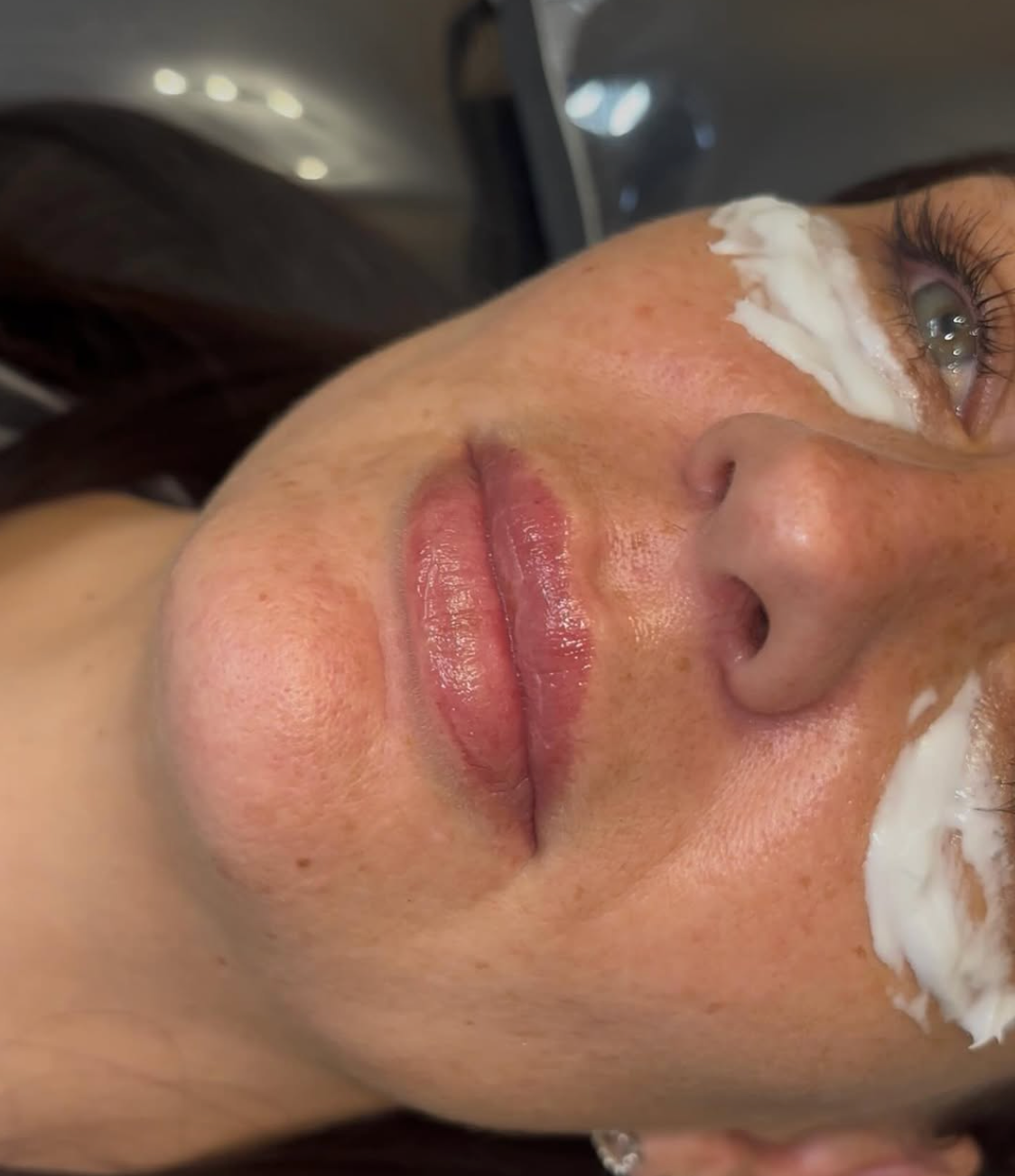 Anti wrinkle injections romford