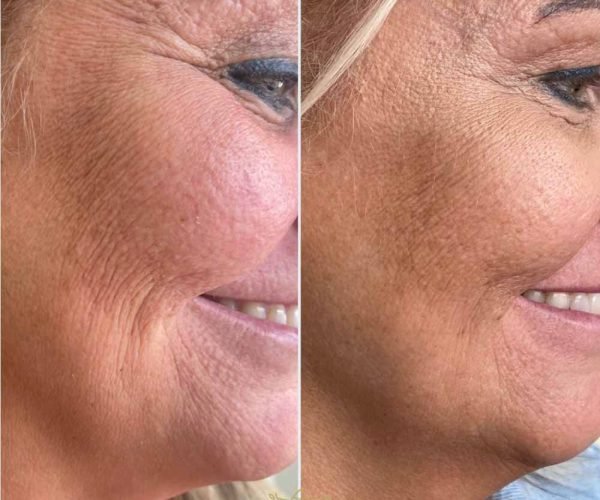 anti-wrinkle treatments romford