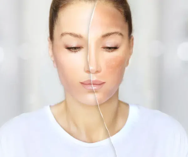 dermal fillers romford